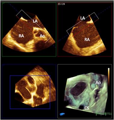 Non-invasive Imaging in the Evaluation of Cardiac Shunts for Interventional Closure